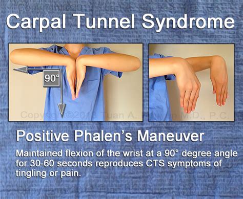 carpal tunnel syndrome hand test